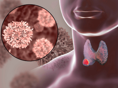 Thyroid Cancer: Detection and Treatment Options in St. Petersburg, FL | Florida Endocrinology