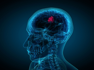 Pituitary Treatments Tampa: Advanced Tumor Care