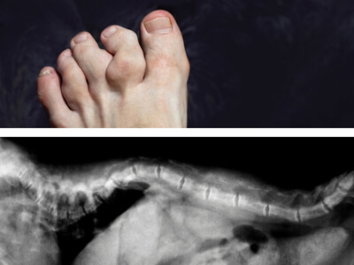 Top 5 Causes of Metabolic Bone Disease in Seniors in the Tampa Bay Area | Florida Endocrinology