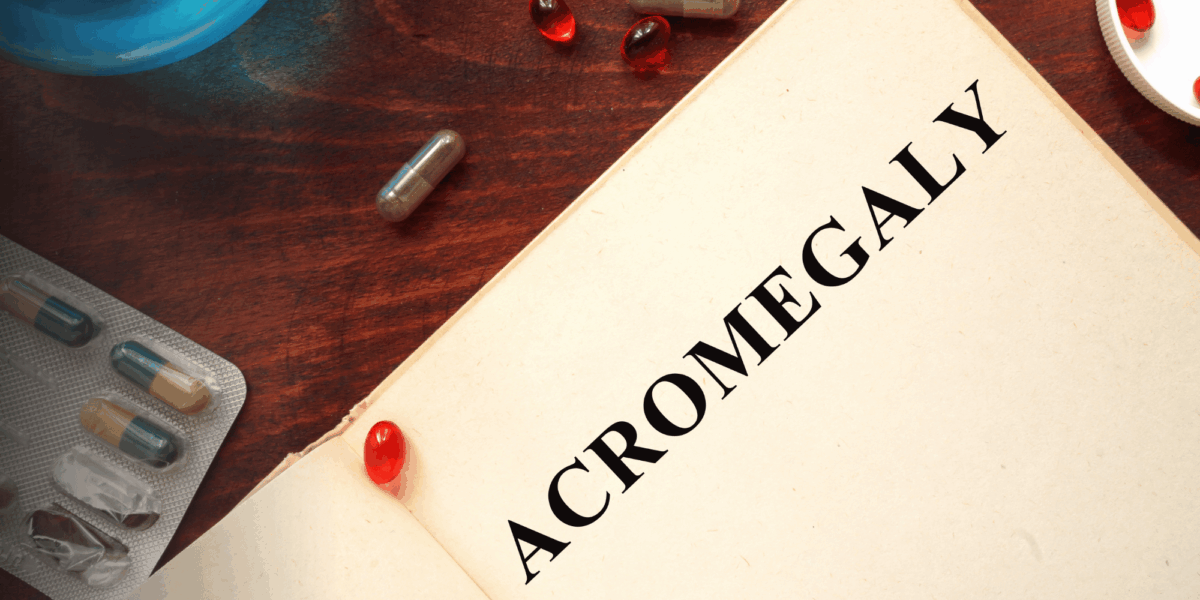 What Is Acromegaly Symptoms, Causes, and Treatment Options Tampa Bay Endocrine