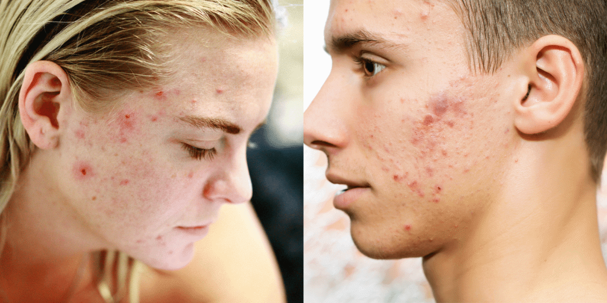 Endocrinologist Adult Cystic Acne